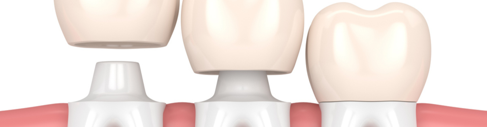 3D image of three teeth receiving dental crowns.